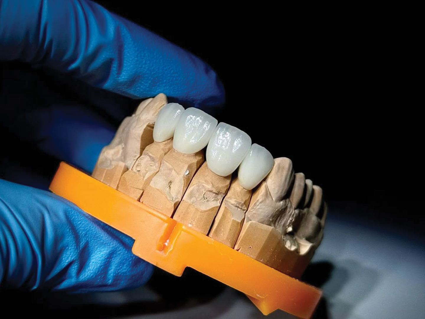 Couronne dentaire zircone stratifiée