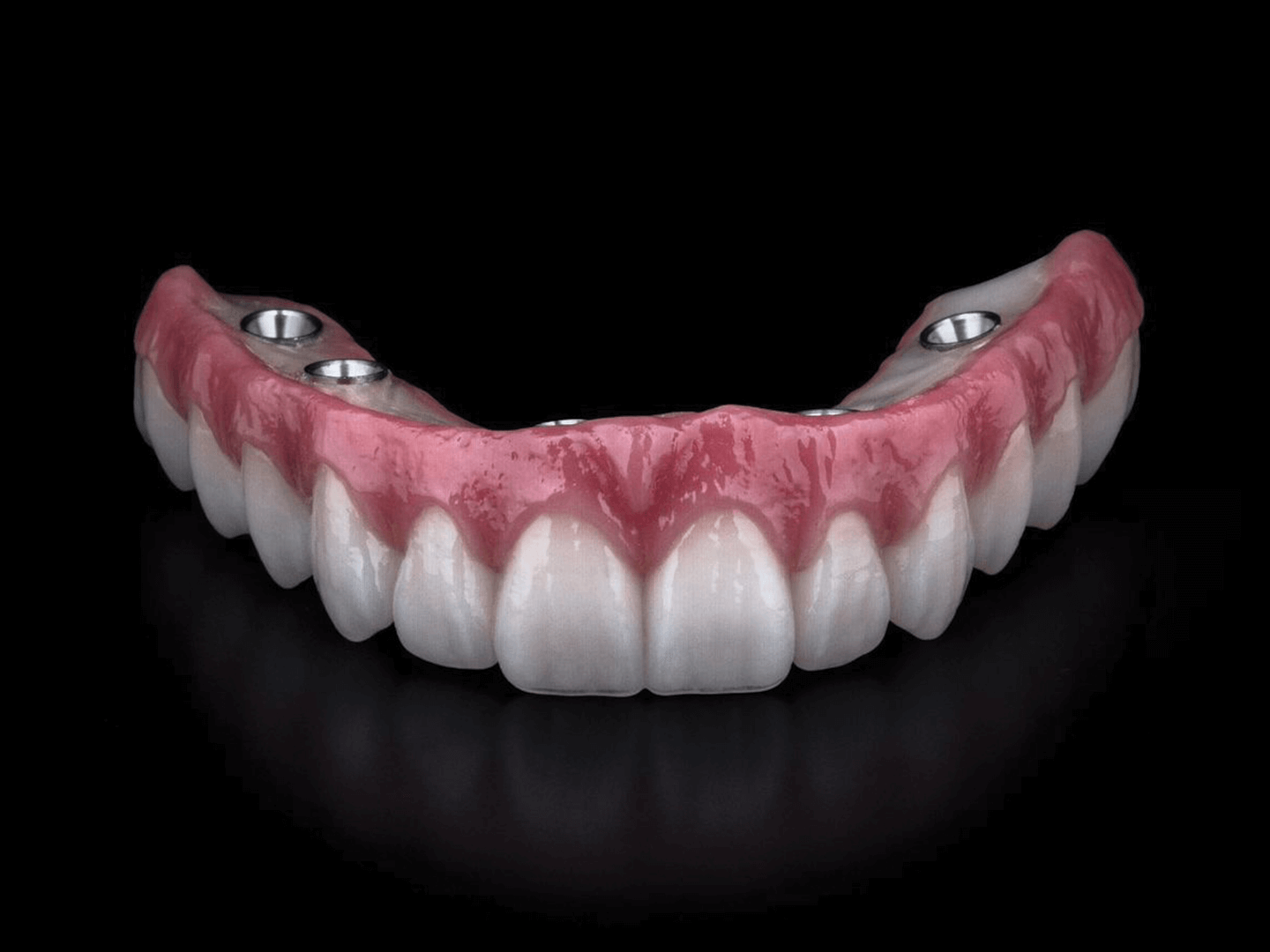 Prothése zircone transvissée sur implant