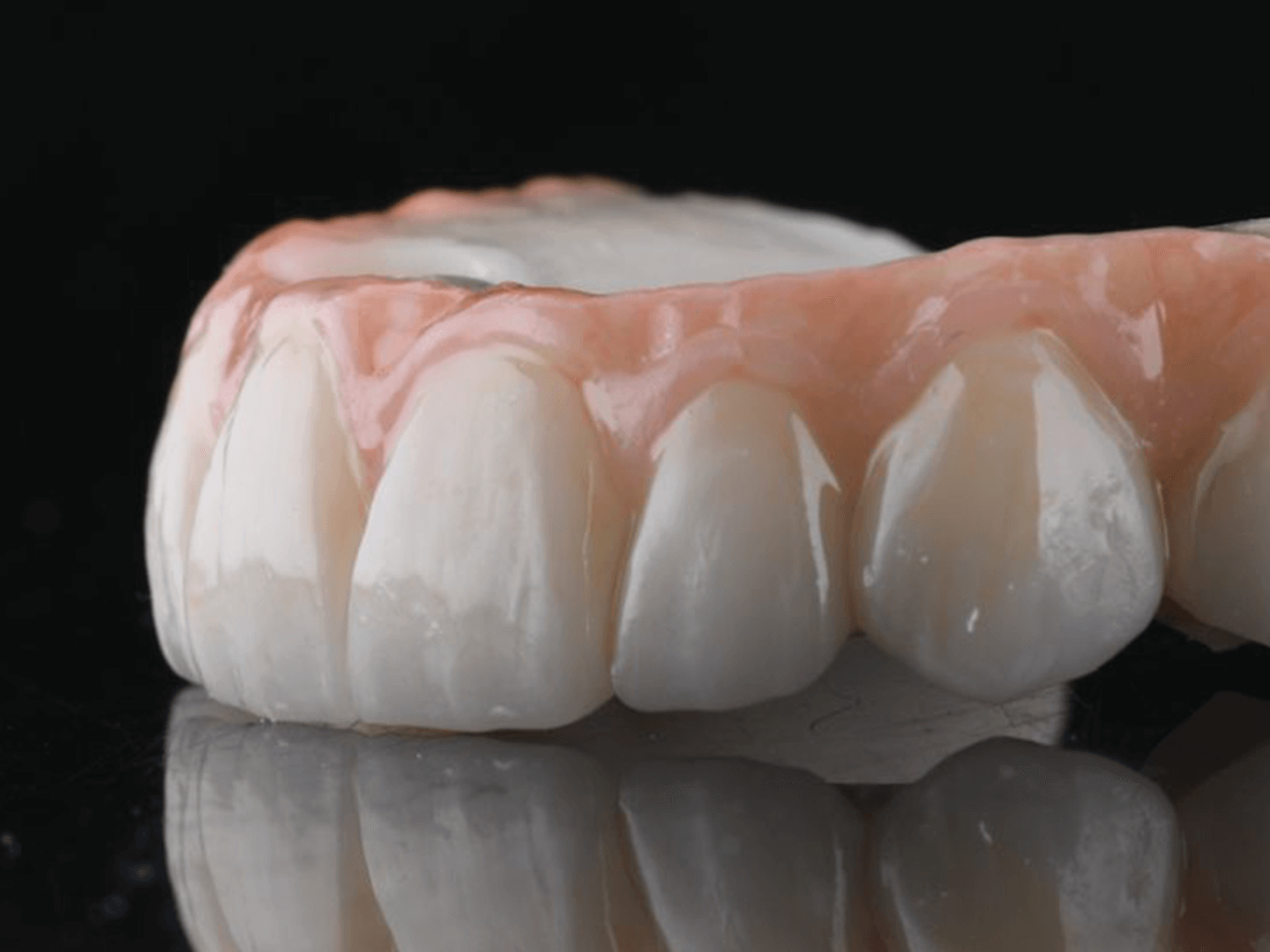 Prothése en zircone scellée sur implant