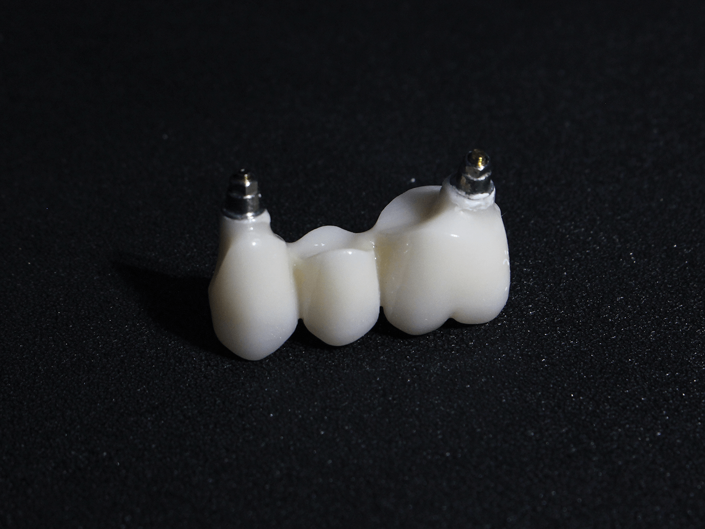 Couronne zircone transvissée sur implant