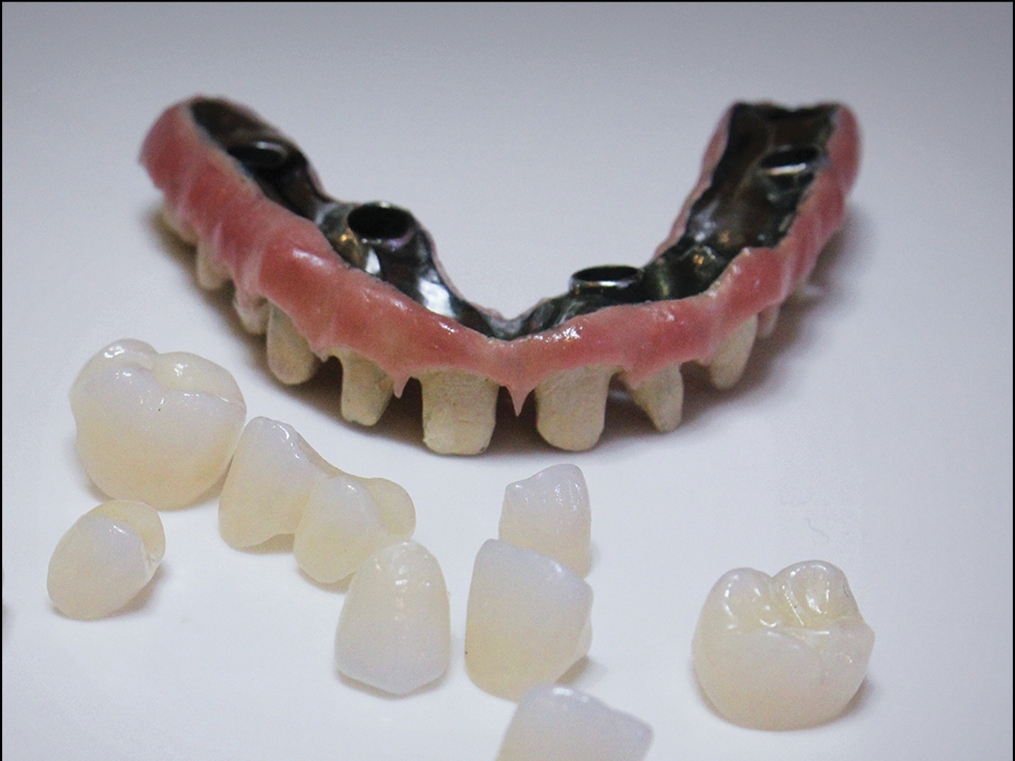 Prothèse transvissée sur implants – type Toronto