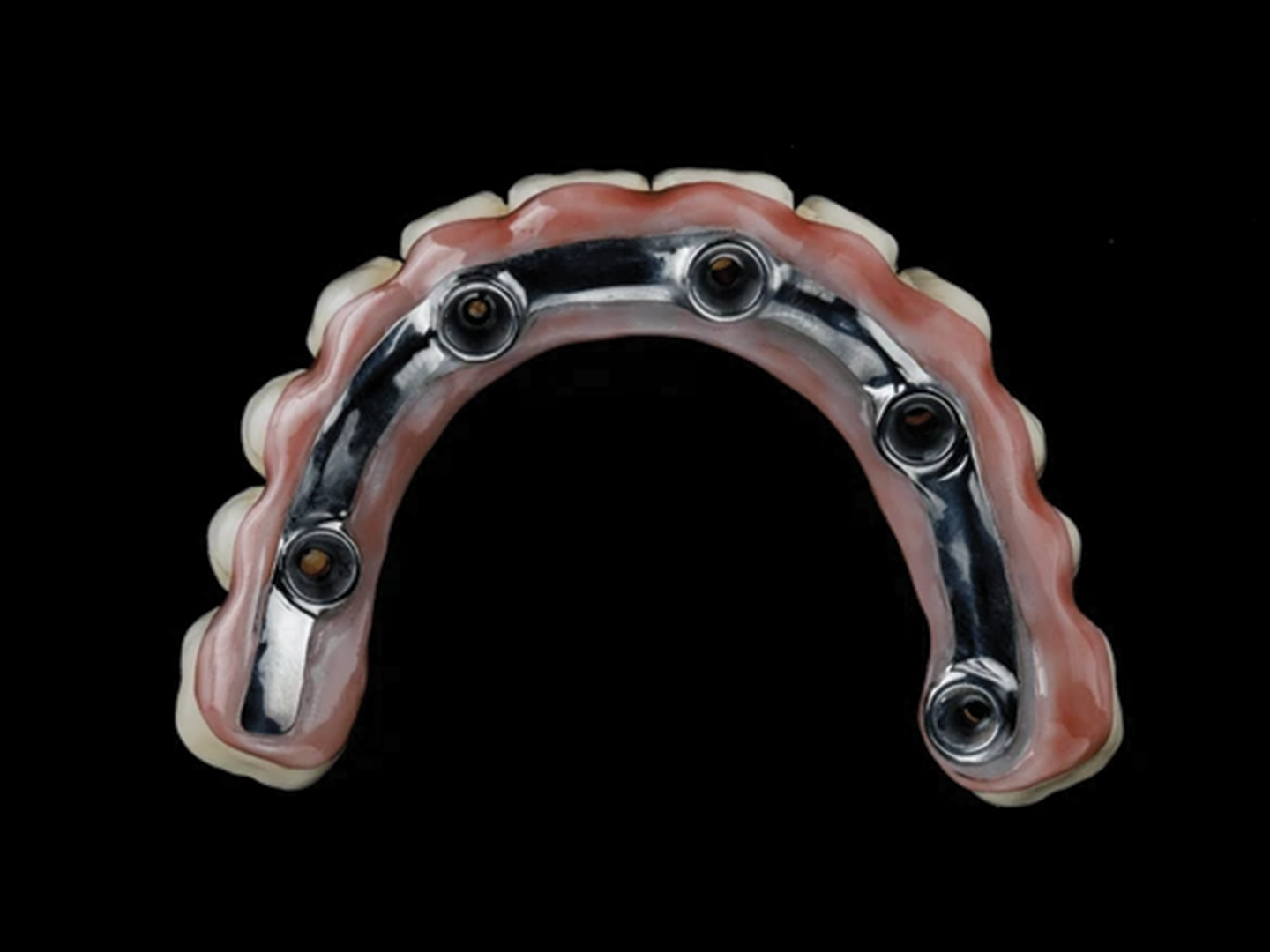 Prothèse en Zircone sur Barre en Titane